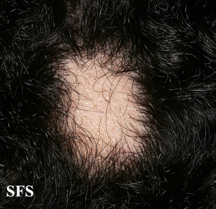 File:Alopecia areata 24.jpeg