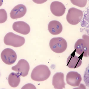 Babesia microti in a thin blood smear stained with Giemsa. Note the intra-erythrocytic vacuolated forms indicated by the black arrows. Adapted from CDC