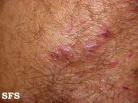 File:Dermatitis herpetiformis10.jpg