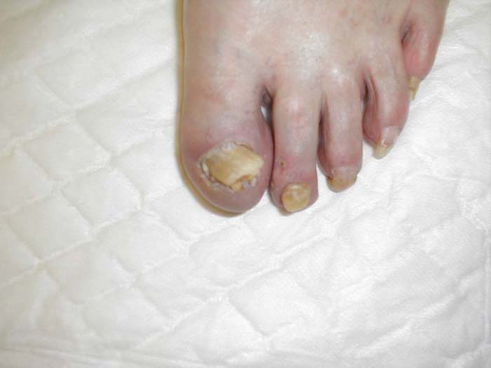 Onychomycosis: Chronic fungal infection causing discoloration and deformity of nails.