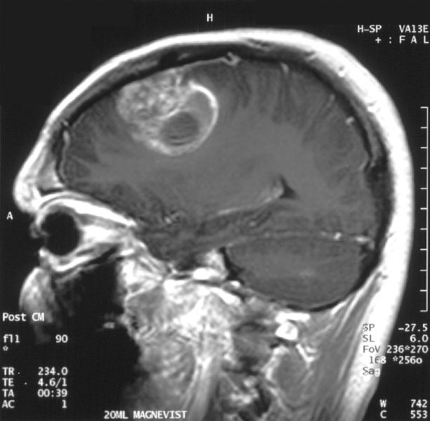 Image 1a. Sagittal MRI with contrast of a glioblastoma WHO grade IV in a 15-year-old boy
