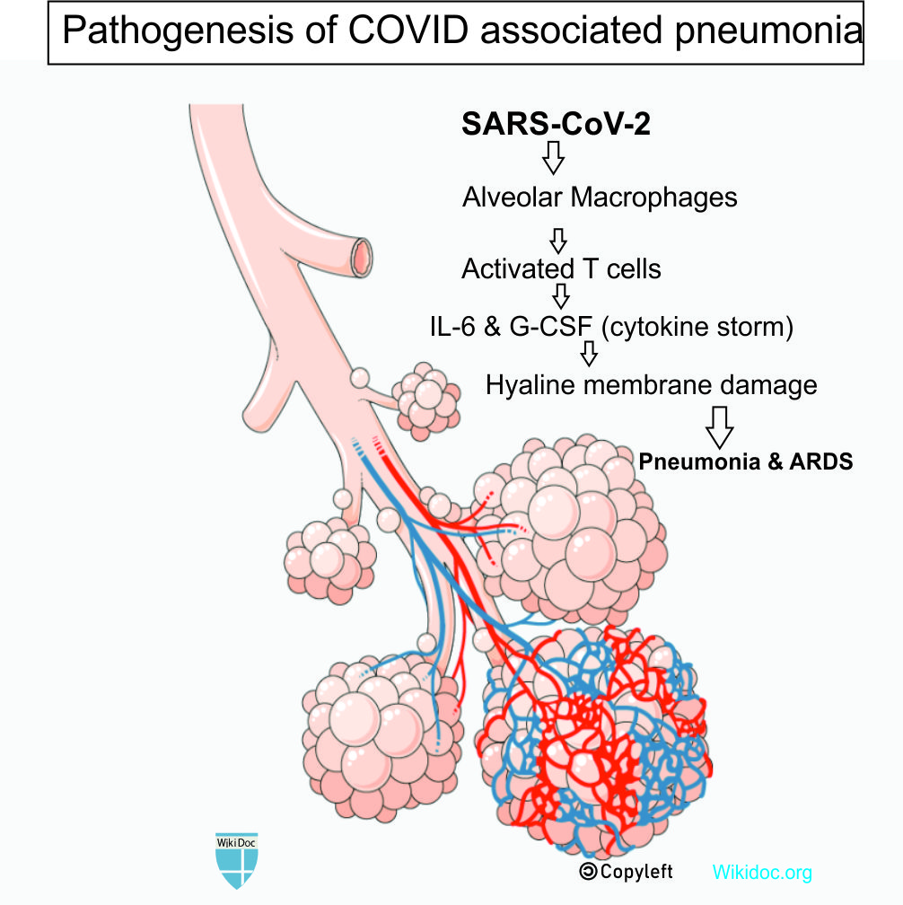 File:Pneumonia pathogenesis.jpg