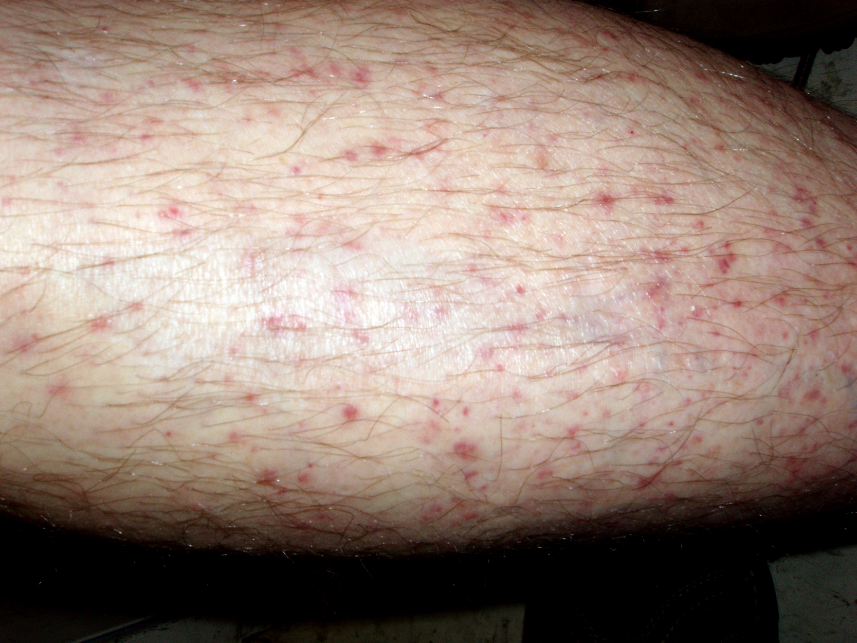 Vasculitis: In this instance, idiopathic.