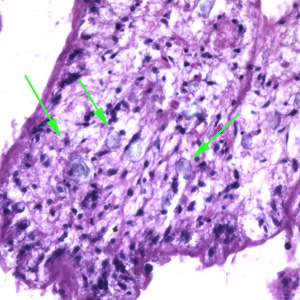 Higher magnification of the sparganum in Figure 1. In this image, calcareous corpuscles (green arrows) can be seen. Adapted from CDC