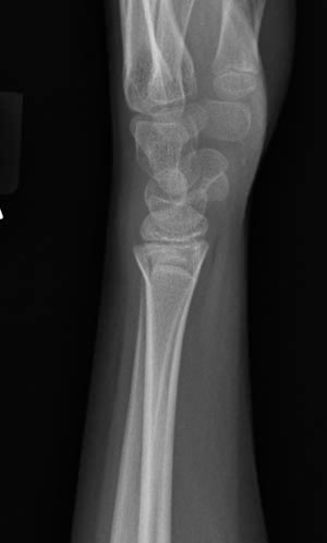 Plain x-ray: Torus fracture