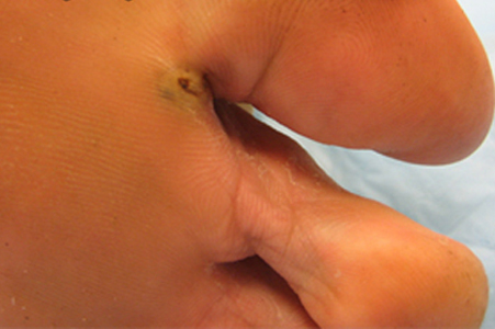 Gross lesion on a patient's foot caused by T. penetrans. Image courtesy of Drs. Mohammed Asmal and Rocio M. Hurtado. Image first appeared at Partners' Infectious Disease Images (http://www.idimages.org), whose content is copyrighted by Partners Healthcare System, Inc., and is used with permission. Adapted from CDC
