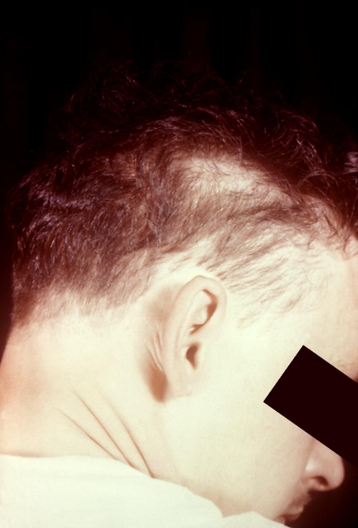 This patient presented with a case of alopecia during the secondary stage of syphilis. Second-stage symptoms can include fever, swollen lymph glands, sore throat, patchy hair loss, headaches, weight loss, muscle aches, and tiredness. The disease can easily be passed to sex partners during the primary or secondary stages. Adapted from CDC