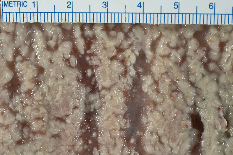 Pseudomembranous colitis. [42]