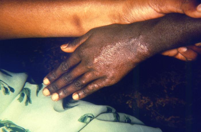 Active cutaneous lesion on left hand consistent with tuberculoid or paucibacillary leprosy. Adapted from Public Health Image Library (PHIL), Centers for Disease Control and Prevention.[6]