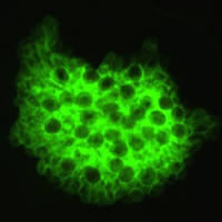 Direct immunofluorescence antibody stain using monoclonal antibodies that target Pneumocystis jirovecii. This image is from a bronchoalveolar lavage (BAL) specimen from a patient with a malignancy. Image courtesy of Brigham & Women's Hospital, Boston, MA. Adapted from CDC