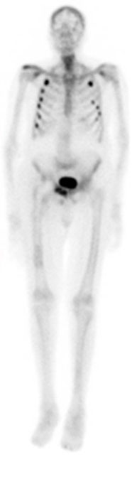 Bone scan demonstrates multiple rib fractures