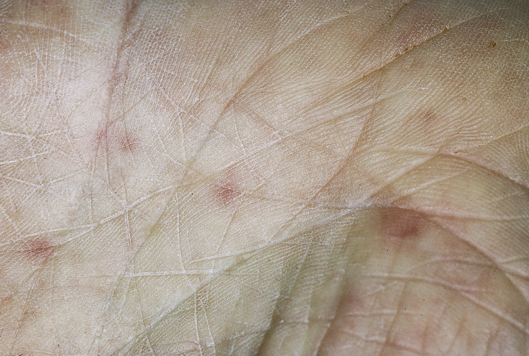 Janeway Lesions: Flat, painless, erythematous lesions seen on the palm of this patient's hand. Frequently associated with bacterial endocarditis.