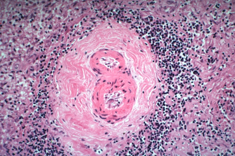 Spleen: Lupus erythematosus, periarterial fibrosis: Micro high may H&E. An excellent example of periarterial fibrosis