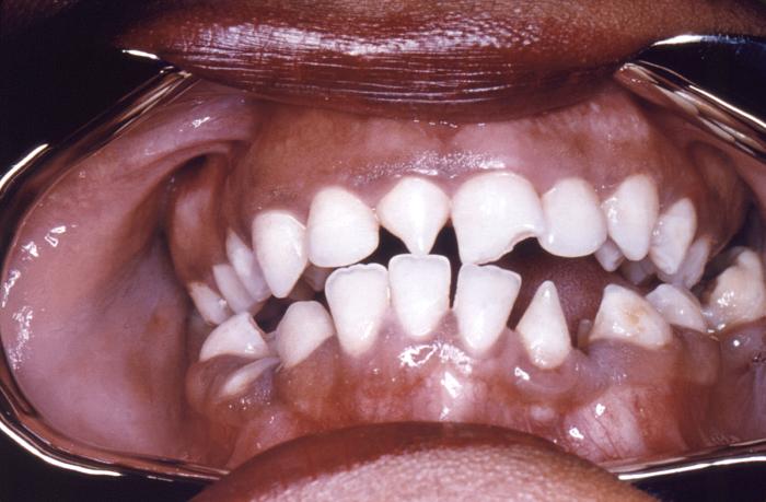 This close-up view demonstrates the dentition within the oral cavity of a young African-American female patient, revealing the triangular-shaped deformity of her right lateral incisor, and the left central incisor, which is known as Hutchinson incisors, and is caused by a congenital syphilitic infection. In this particular case, at the time of her birth, one of this woman’s parents tested positive for syphilis. Congenital syphilis, is a condition caused by infection in utero with Treponema pallidum. A wide spectrum of severity exists, and only severe cases are clinically apparent at birth. An infant or child (aged less than 2 years) may have signs such as hepatosplenomegaly, rash, condyloma lata, snuffles, jaundice (nonviral hepatitis), pseudoparalysis, anemia, or edema (nephrotic syndrome and/or malnutrition). An older child may have stigmata (e.g., interstitial keratitis, nerve deafness, anterior bowing of shins, frontal bossing, mulberry molars, Hutchinson teeth, saddle nose, rhagades, or Clutton joints). Adapted from CDC