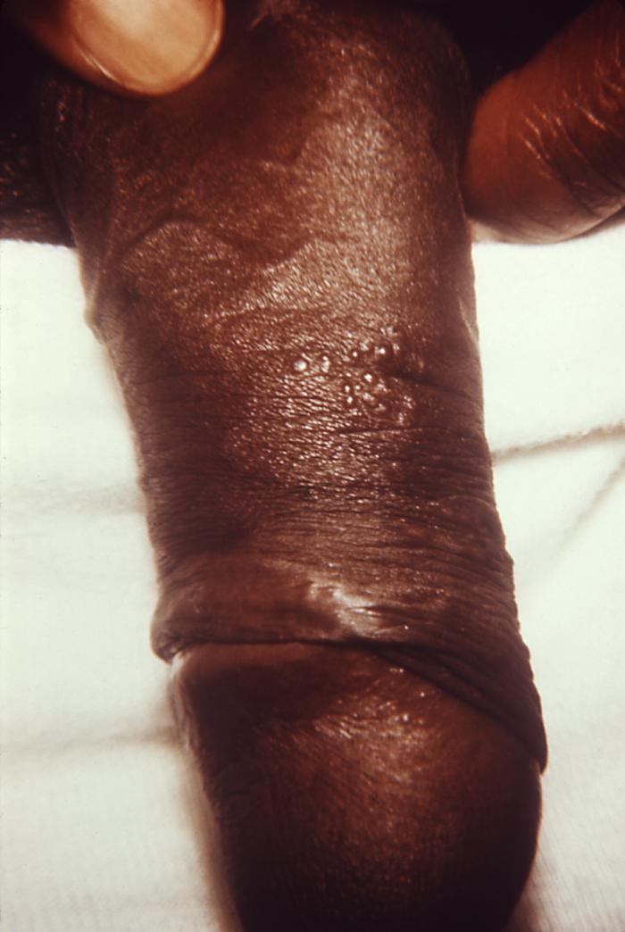 Though initially thought to be herpes lesions, the differential diagnostic process showed these to be syphilitic in nature. Syphilis is a complex sexually transmitted disease (STD) caused by the bacterium Treponema pallidum. It has often been called "the great imitator" because so many of the signs and symptoms are indistinguishable from those of other diseases. Adapted from CDC