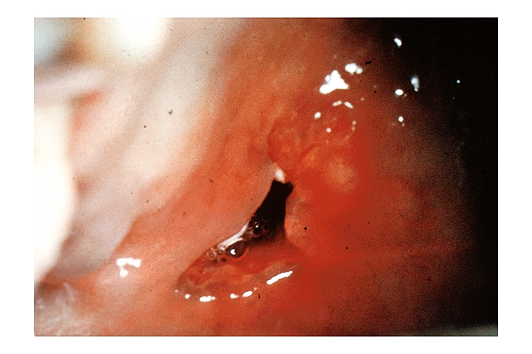 File:Mucoepidermoid carcinoma oral 001.jpg