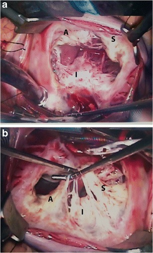 File:Normal anatomy of tricuspid valve.jpg