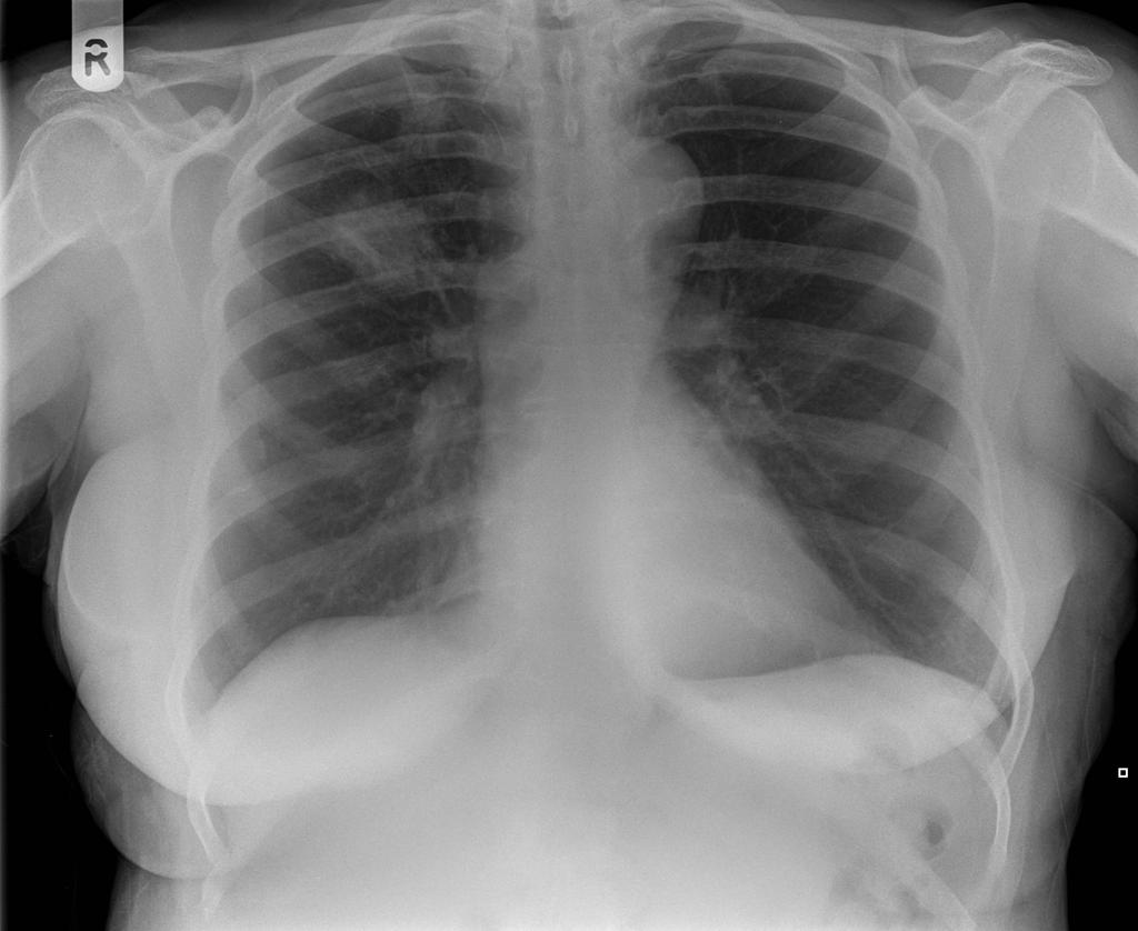 Coin lesion sign: round or oval, well-circumscribed lesion, compatible with primary lung cancer. Case courtesy of Dr Ian Bickle. Source:Radiopedia.org [5]