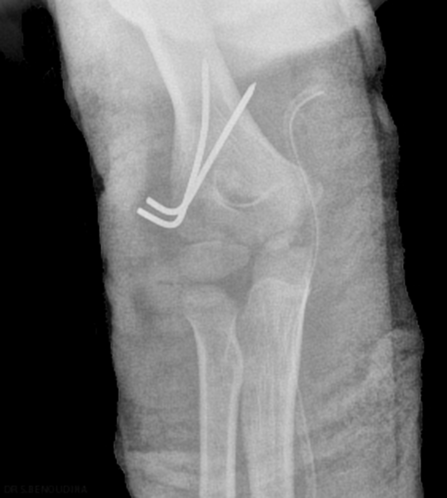 Internal fixation using two Kirschner wires laterally.