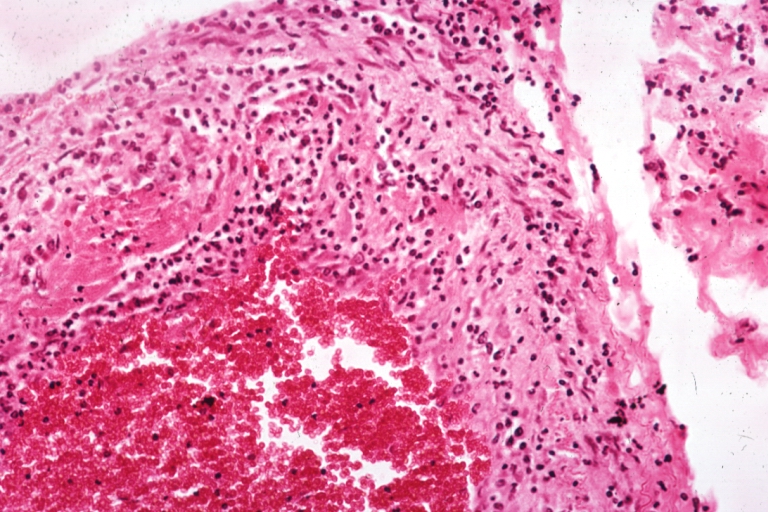 Artery: Arteritis in Lupus Erythematosus: Micro med mag H&E. A good example of vasculitis