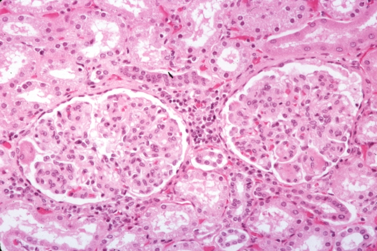 Kidney: Lupus Erythematosus: Micro med mag H&E two glomeruli showing lobular glomerulonephritis lesion