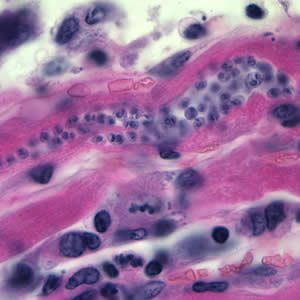 Trypanosoma cruzi amastigotes in heart tissue. The section is stained with hematoxylin and eosin (H&E). Adapted from CDC