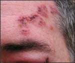 File:Herpes zoster 5.jpg