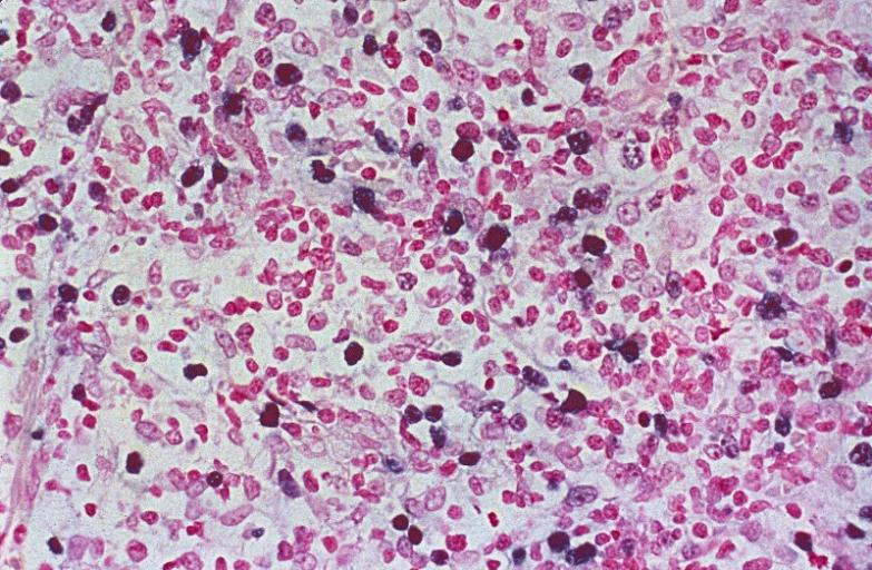 LOWER RESPIRATORY TRACT: (Supplement) AIL/LYG CD20 staining (for B cells) in the viable tissue shows positive staining of scattered large lymphoid cells (C) which were also the cells that were positive for Epstein-Barr virus by in situ hybridization