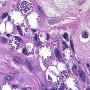 Amastigotes of Leishmania sp. in a biopsy specimen from a skin lesion, stained with hematoxylin and eosin (H&E). Adapted from CDC
