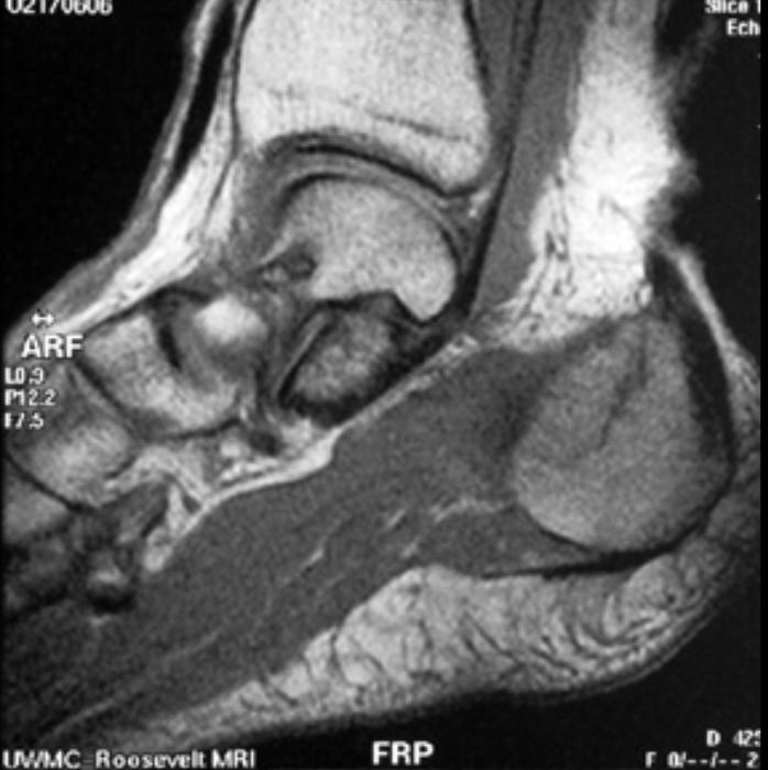 File:Stress-fracture-102.jpg