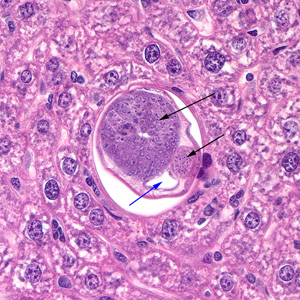 Cross section of a male C. hepatica in liver tissue, stained with hematoxylin and eosin (H&E). Note the presence of the intestine (blue arrow) and the coiled sections of the testes (black arrows). Adapted from CDC