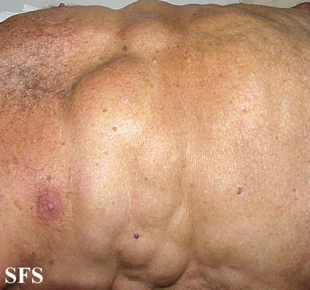 Multiple symmetric lipomatosis. Adapted from Dermatology Atlas.[5]