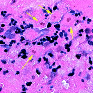 Four trophozoites (yellow arrows) of S. pedata in brain tissue, stained with hematoxylin and eosin (H&E). In three of the amebae, the two nuclei can easily be seen. Adapted from CDC