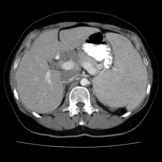 File:Splenic marginal zone lymphoma CT.jpg
