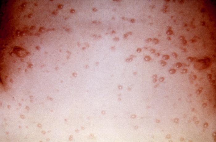 This 7 year old child presented with a generalized herpes simplex vesiculopapular rash over his trunk 5 days after onset. Herpes simplex virus, otherwise known as Herpesvirus hominis is a member of a group of viruses including those which cause oral herpes, i.e., usually HSV-1, and genital herpes, i.e., usually HSV-2.