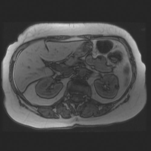MRI: Angiomyolipoma[1]