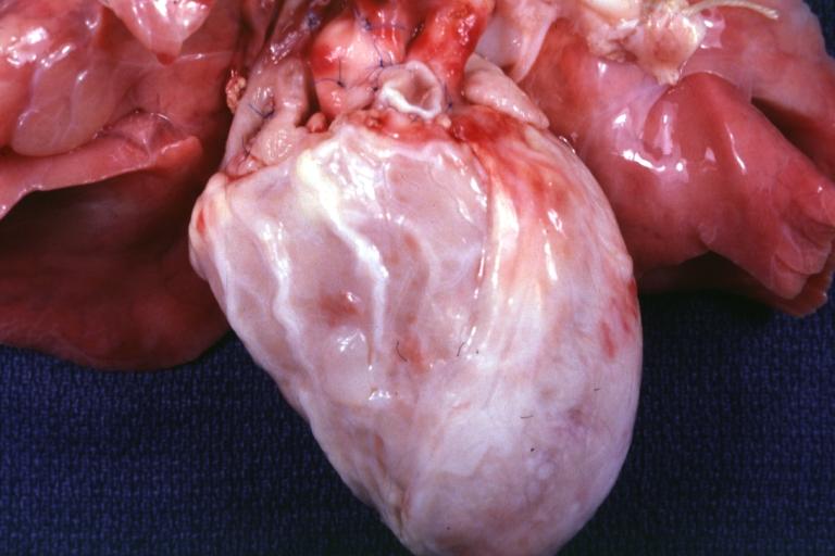 Coronary Artery Anomalous Origin Left from Pulmonary artery: Gross natural color anterior view of heart. Large marginal type coronary branches over anterior aspect of right ventricle.