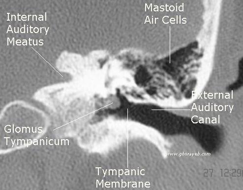 Coronal CT scan showing the glomus tympanicum tumor growing from the medial wall of the middle ear[6].