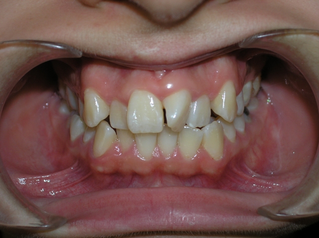 Before Orthodontic treatment (Frontal view)