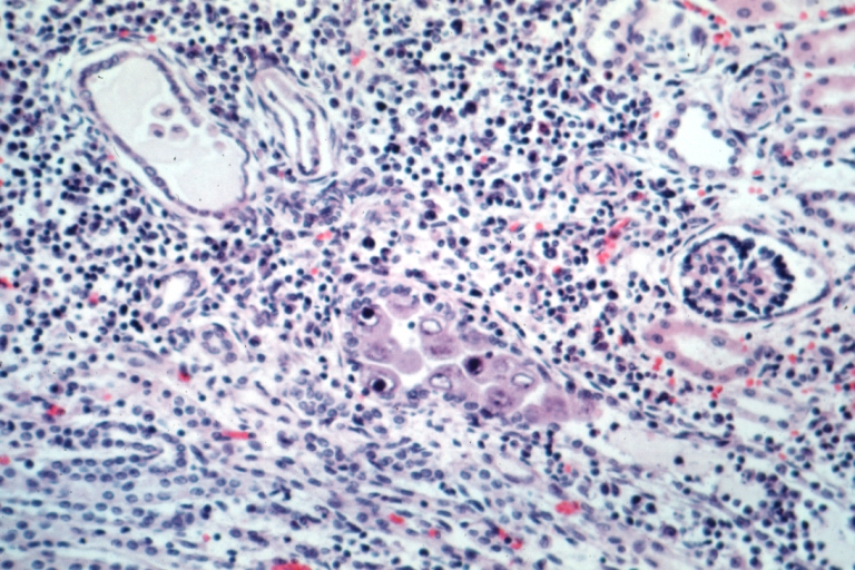 Kidney: Cytomegalic Inclusion Body Disease: Micro med mag H&E inclusions easily seen