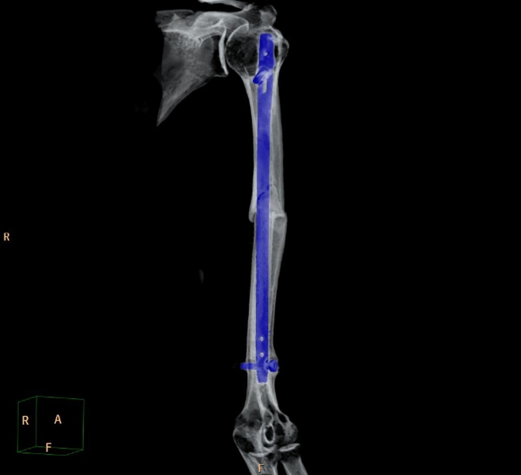 3D- Fracture of the middle third of the humerus, with small shifting and no signs of consolidation.