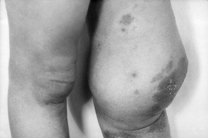 Photograph of neuropathic arthropathy (Charcot joint) resulting from tertiary syphilis. This patient sustained progressive destruction, degeneration, and disorganization of the knee joint resulting from a loss of sensation caused by long standing tabes dorsalis. This condition was brought on during tertiary syphilis. Adapted from CDC