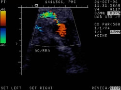 File:Renal artery stenosis 003.jpg