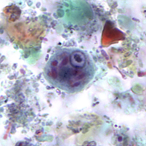 Cyst of E. polecki stained with trichrome. Notice the large nucleus with a pleomorphic karyosome and numerous variably-shaped chromatoid bodies. Adapted from CDC