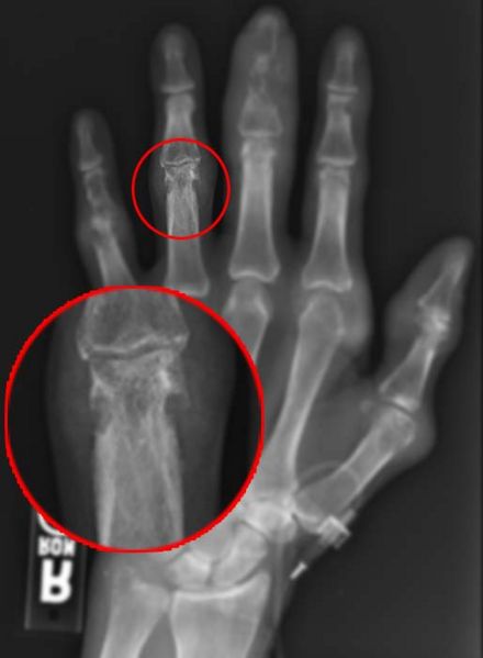 Gout x ray - wikidoc