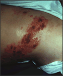 File:Herpes zoster4.jpg