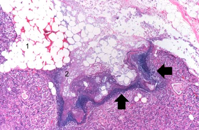 This low-power photomicrograph of the pancreas from this case shows the fat tissue (1) surrounding the pancreas. Note the rim of inflammatory cells (arrows) and the blue areas in the fat adjacent to the pancreas (2).