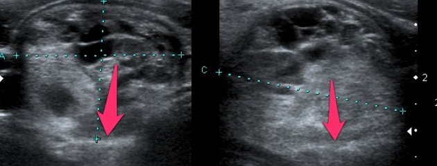 File:Papillary thyroid cancer ultrasound 05.jpeg