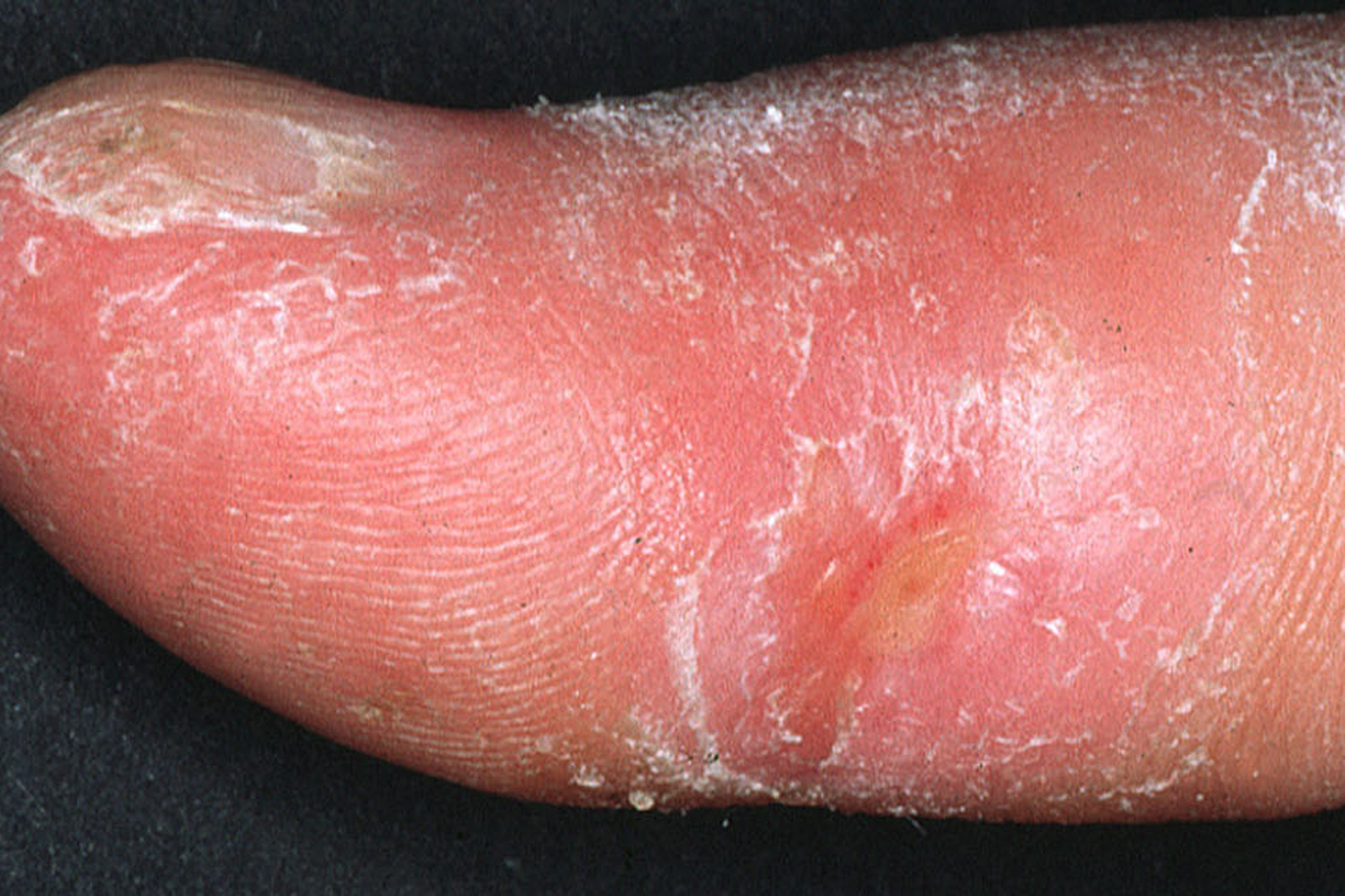 Clinical appearance of acrosclerotic piece-meal necrosis of the thumb in a patient with systemic sclerosis.