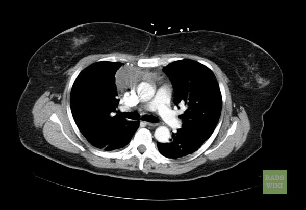 CT shows Thymoma (Image courtesy of RadsWiki and copylefted)